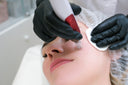 Microneedling Aftercare