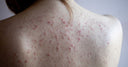 The Ultimate Guide to Preventing and Treating Acne on Your Chest and Back - The Vancouver Aesthetician