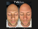 Before and after microneedling results after 1 treatment, showing improved skin texture, reduced wrinkles, and glowing complexion.