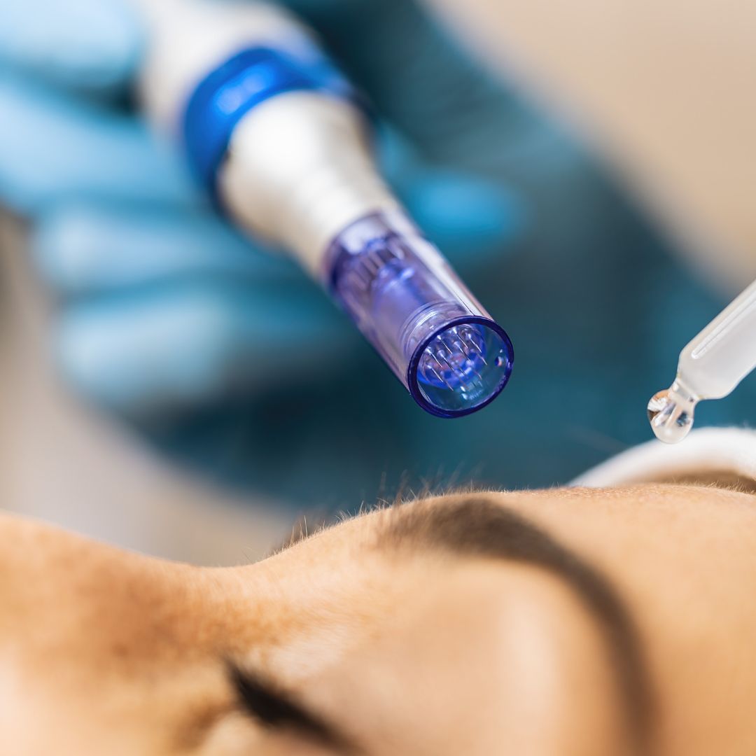 Traditional Microneedling Package of 6