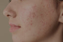 Customized acne facial treatments at a trusted facial spa near you in Vancouver.