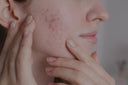 Reduce acne scarring with advanced facial spa services in Vancouver—see visible results fast.