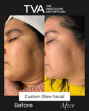 Before and after of Custom Glow Facial in Vancouver showing radiant results on dry skin, a top women’s facial, and an affordable microcurrent glow facial.