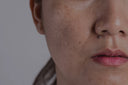 Target dark spots and hyperpigmentation with advanced facial treatments in Vancouver, BC.