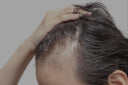 Microneedling treatment for hair growth on scalp at clinical studio in Vancouver BC