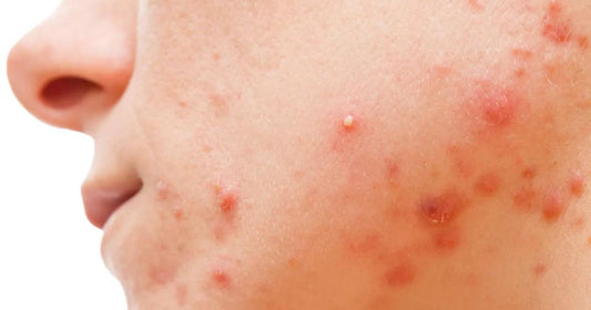 A Comprehensive Guide to Acne Types and Treatments: From Blackheads to Cysts