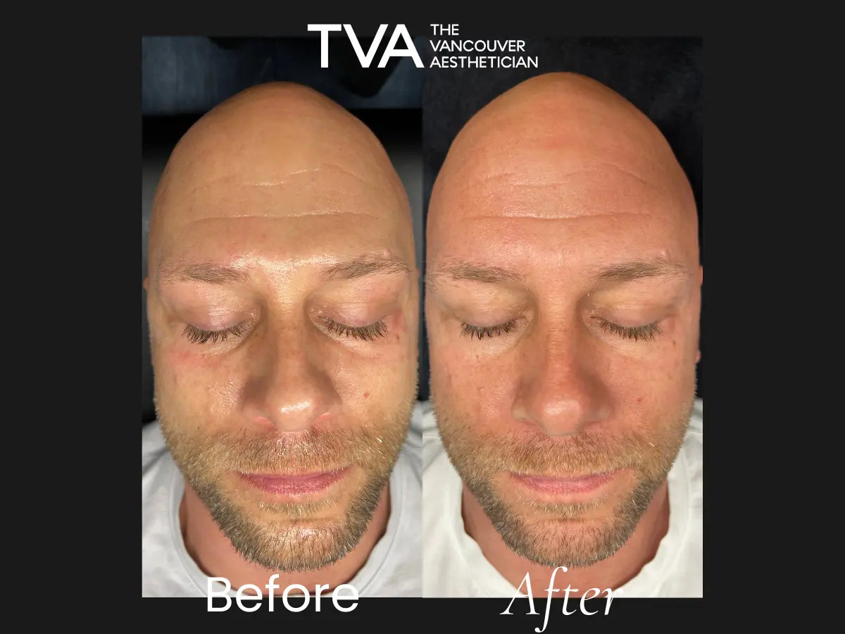 https://thevancouveraesthetician.com/cdn/shop/articles/microneedling-before-after-1-treatment-results.webp?v=1746114563