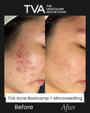 Before and after of a woman who completed The Vancouver Aesthetician’s Acne Bootcamp and microneedling with growth factors, showing dramatic acne scar reduction, smoother skin texture, and clearer complexion.