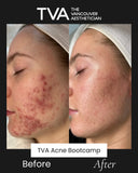Before and after results of Acne Specialist Facial and Acne Bootcamp in Vancouver, showing clear skin transformation and effective hormonal acne treatment.