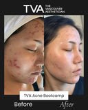 Incredible before and after of a client completing the best facial for acne in Vancouver, with Acne Bootcamp and facials for acne achieving dramatic results.