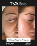 Before and after results of The Vancouver Aesthetician’s Age Reverse Program, featuring DMK Enzyme Therapy, showing anti-aging skin improvements and rejuvenation.