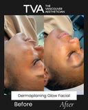 Before and after results of dermaplaning facial near me, highlighting ladies’ facial hair removal, glowing skin, and improved texture.