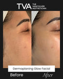 Before and after of Dermaplaning Glow Facial in Vancouver showing facial hair removal, smoother skin, and instant brightening for women.