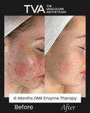 Before and after results of a 4-month DMK Enzyme Therapy treatment in Vancouver, showing dramatic skin improvement from DMK enzyme facial, mask, and oxygen therapy.