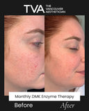 Before and after of monthly DMK Enzyme Therapy treatments in Vancouver showing improved overall skin health, reduced redness, smoother texture, and clearer acne-prone skin.