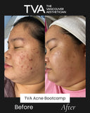 Visible before and after improvements from Acne Specialist Facial and Acne Bootcamp in Vancouver, answering the question: do facials help with acne? Yes!