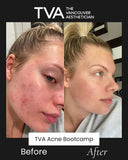 Before and after image showing the power of facials for acne and hormonal acne treatment in Vancouver through The Vancouver Aesthetician’s Acne Bootcamp.