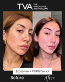 Before and after results of The Vancouver Aesthetician’s Microchanneling Exosome + PDRN Facial, showing improved skin brightness, anti-aging effects, smoother texture, reduced pores, and hyperpigmentation treatment.