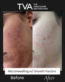 Before and after microneedling with growth factors on a woman in Vancouver, with visible reduction in acne scarring and smoother skin appearance.