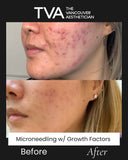 Before and after microneedling with growth factors on a woman in Vancouver, showing significant improvement in acne scars and skin texture.