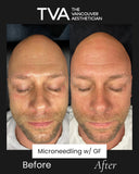 Before and after microneedling with growth factors on a man showing reduced fine lines, youthful under eyes, and visible anti-aging benefits in Vancouver.