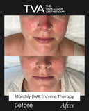 Before and after results of monthly DMK Enzyme Therapy treatments in Vancouver for rosacea, showing reduced redness, calmer skin, and improved texture.